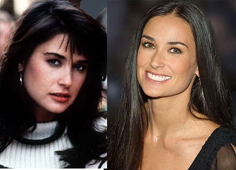 demi moore avant/après la chirurgie esthétique