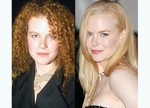 nicole kidman avant/apres la chirurgie esthétique