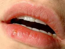 herpes buccal